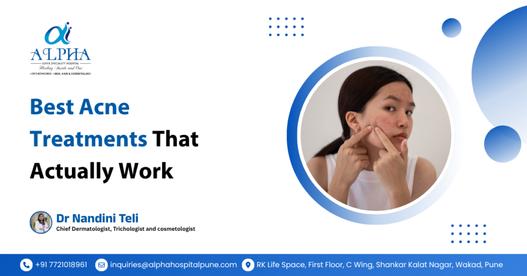 Best Acne Treatments That Actually Work - Dr. Nandini Teli