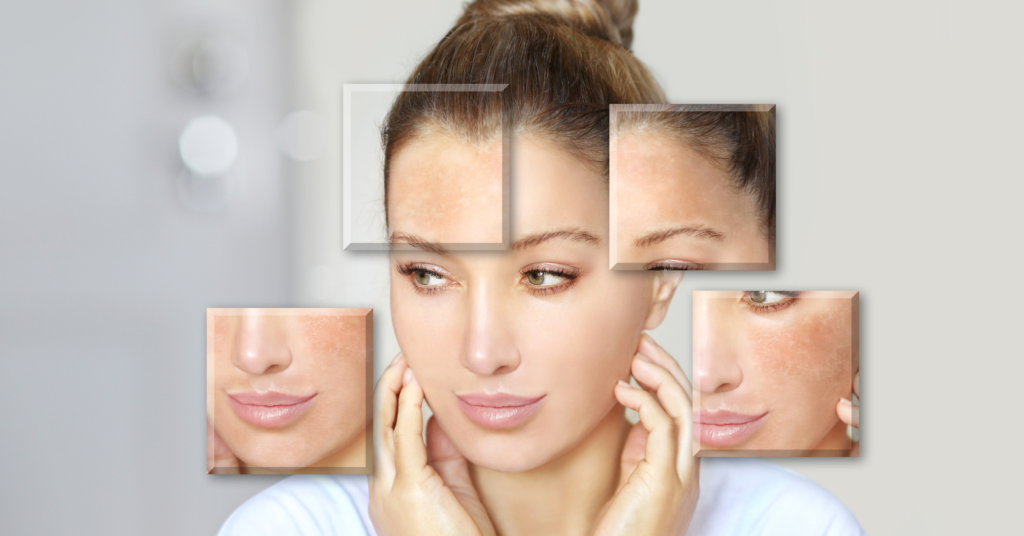 PCOD & Skin Problems: Best Dermatologist-Recommended Treatments for Clear Skin - Dr. Nandini Teli